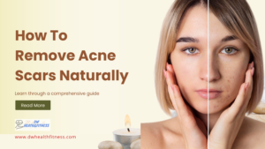 how to remove acne scars naturally